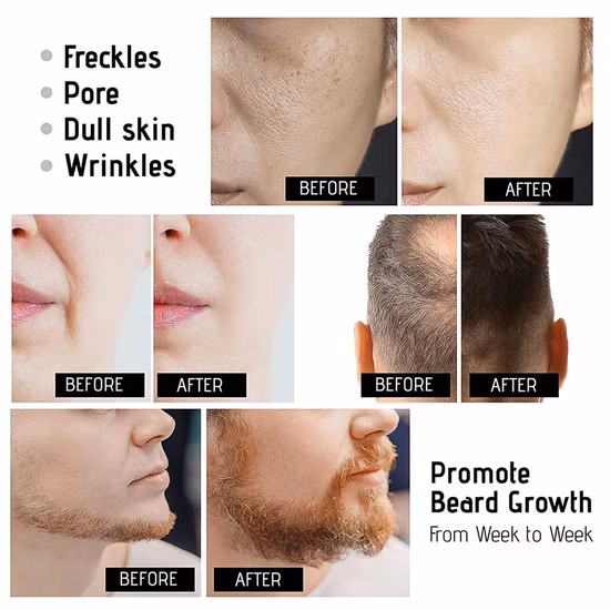 Venda quente de marca própria Matt Micro Needle Matte Black 540 Derma Roller